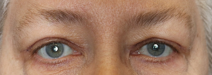 Upper Blepharoplasty and Brow Lift – Case 1